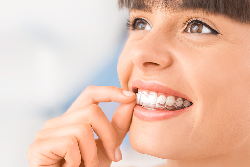 Clear Aligners in Monsey